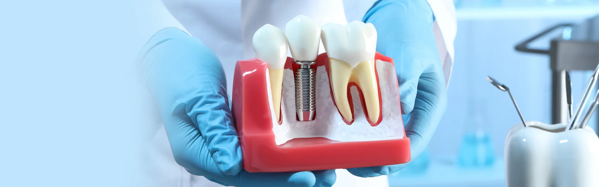 What Can I Eat After a Dental Implant Surgery?